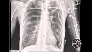 Xray Interpretation  Cavitary Lesions [upl. by Nue]