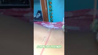 Acupuncture treatment done by Dr Subhashis Debnath [upl. by Mccarthy220]