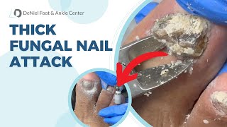 Thick Fungal Nail Attack toenailfungustreatment toenailfungus footdoctor [upl. by Fritts]