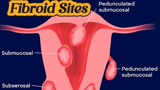 Fibroid Uterus  Mass Uterus  DUB on Ultrasound [upl. by Aeriell]