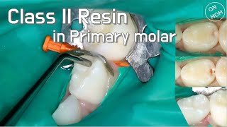 Class II resin restoration in children [upl. by Murdock432]