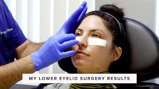 Real Lower Blepharoplasty Recovery amp Results  In the OR Part 3 of 3 [upl. by Durgy961]