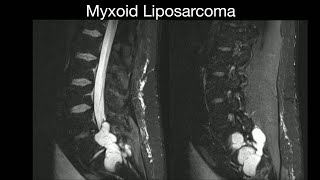 Myxoid Liposarcoma [upl. by Enrobialc775]