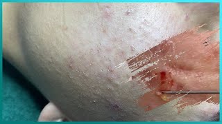 Big Cystic Acne Blackheads Extraction Blackheads amp Milia Whiteheads Removal Pimple Popping [upl. by Tzong362]