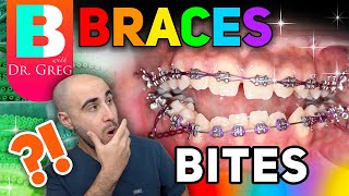 Braces Overbite Overjet Underbite Crossbite amp Open Bite Explained [upl. by Jegger]