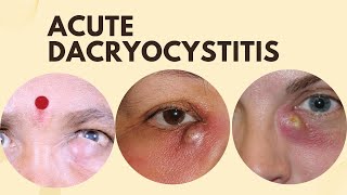 Acute Dacryocystitis [upl. by Inalel]