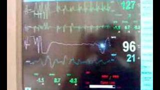 Chemical cardioversion of SVT [upl. by Einolem114]