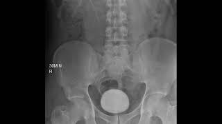 CASE 395 intravenous pyelography IVP left renal agenesis [upl. by Pernas]