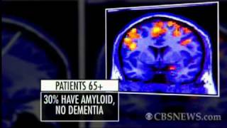 Scan May Predict Alzheimers [upl. by Lauryn]