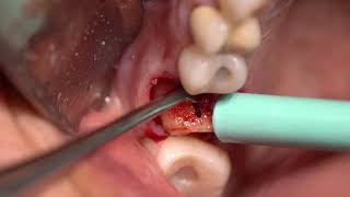 Ext Implant and Bone Graft with Complication [upl. by Sigmund]