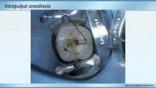 Anesthesia and Rubber Dams  Dr Diwakar Kinra  Dentsply Sirona [upl. by Ennyrb]