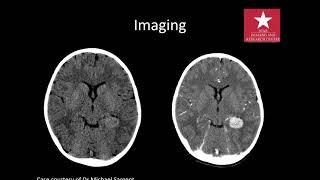 imaging of Intraventricular tumours [upl. by Einre393]