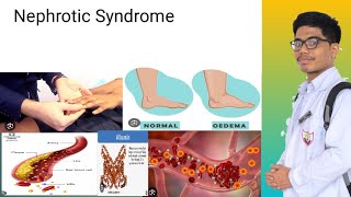 Nephrotic Syndrome  Signs and Symptoms of Nephrotic Syndrome [upl. by Edd]