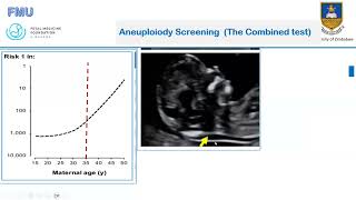 Preeclampsia and Aneuploidy Screening Updated [upl. by Anatnahs561]