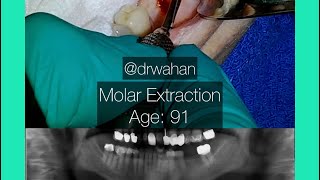 Molar Extraction with Cowhorn Forceps Age 91 [upl. by Frieda]