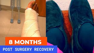 Haglund’s Deformity Surgery Recovery Update 8 months later [upl. by Eulaliah]