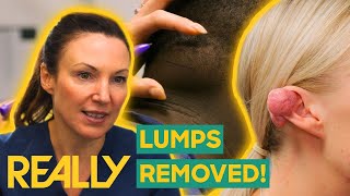 Dr Emma Removes Painful Lipoma and Keloid From The Neck And Ear  The Bad Skin Clinic [upl. by Ancalin985]