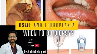 Osmf and leukoplakia when to do biopsy [upl. by Florin325]