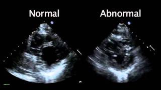 Echocardiogram from the Patient Compared with That from a Normal Control  NEJM [upl. by Sileas]