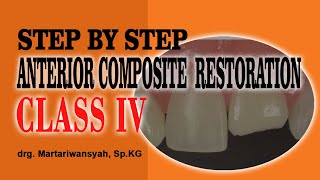 Step by Step Anterior Direct Composite Restoration Class IV AMARIS®  VOCO GmbH Layering Technique [upl. by Honig516]