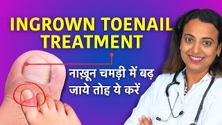 Ingrown Toenail Treatment in Hindi  Home Remedy Using Dental Floss Cotton [upl. by Brost202]