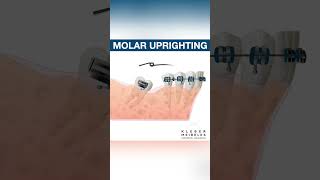 MOLAR UPRIGHTING  ORTHODONTIC TIPS Shorts [upl. by Icyaj752]