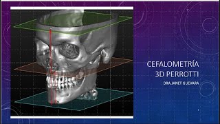 Cefalometría 3D PERROTI Dra Janet Guevara Reyes [upl. by Nadoj]