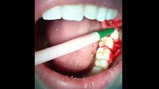 Cirurgia Remoção Terceiro Molar Incluso [upl. by Elbas222]