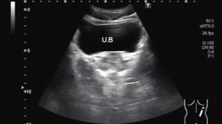 Stone in Ureter with minimum hydronephrosis and hydroureter [upl. by Iggep]