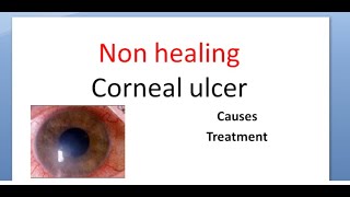 Ophthalmology 114 a Non healing corneal ulcer Cornea Causes Treatment [upl. by Airamana]