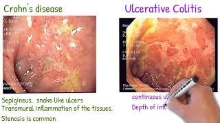 Crohns disease vs Ulcerative Colitis made simply [upl. by Otina]