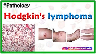 Hodgkins lymphoma Lymphogranulomatosis  Usmle Imaged based discussion [upl. by Arihsa189]