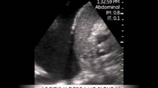 VSCAN Constrictive pericarditis Pocket Ultrasound Pericarditis constrictiva ECO DE BOLSILLO [upl. by Guss541]