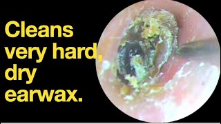 Cleans very hard dry earwax ear wax removal  ear cleaning  ASMR  relaxation  relax [upl. by Einniw]