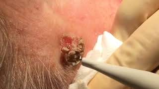 Removal of Seborrhoeic Wart [upl. by Eecrad]