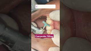 Cosmetic filling in upper front tooth  Composite Filling  Teeth filing composite dentist [upl. by Oregolac]