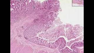 Histopathology ColonAdenocarcinoma [upl. by Patton]