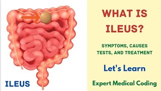 What is Ileus  Symptoms  Causes  Complications  Tests  Treatment Precautions Medical Coding [upl. by Ramedlab]