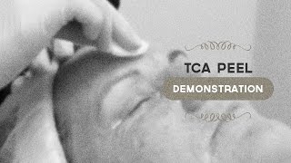 35 TCA peel demonstration [upl. by Felt]