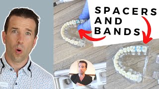 Orthodontist Explains Spacers and bands shorts [upl. by Laehcor653]