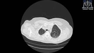 SCANNER THORACIQUE  Pleurésie bilatérale déjà traité pour TBK pulmonaire [upl. by Derfliw449]