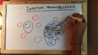 Infectious Mononucleosis [upl. by Marrin]