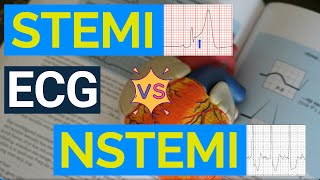 Decoding ECG Changes STEMI vs NSTEMI  A Comprehensive Guide to Heart Attack Diagnosis [upl. by Farlay]