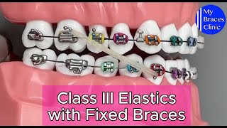 How to wear Class III Elastics with Fixed Braces [upl. by Dev614]