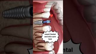 implant ❤️ dentistry lmplant tooth dentist [upl. by Analli]