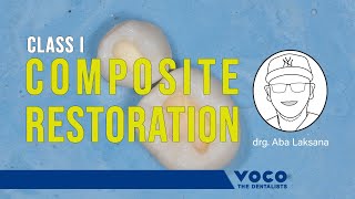 Penambalan Resin Komposit Posterior  Direct Composite Restoration Class I  Polofil Supra VOCO [upl. by Tharp]