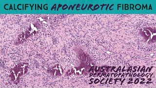 Calcifying aponeurotic fibroma rare benign handfoot tumor in a child soft tissue pathology [upl. by Syl]