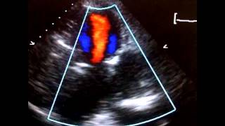 Echocardiogram Pseudoaneurysm Inferolateral LV [upl. by Rasia]