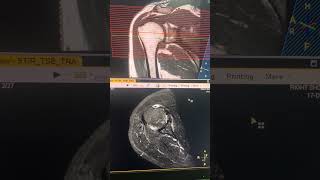 MRI Right Shoulder Tear tendon [upl. by Gothurd]