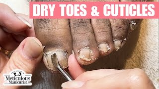 Discolored Dry Toenails Transformation [upl. by Ynohta]